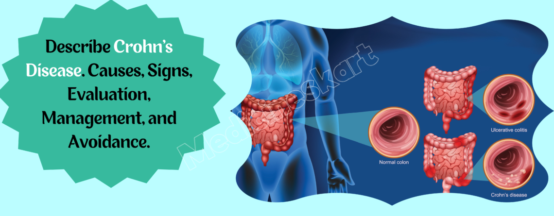 Describe Crohn's disease. Causes, Signs, Evaluation, Management, and Avoidance..png