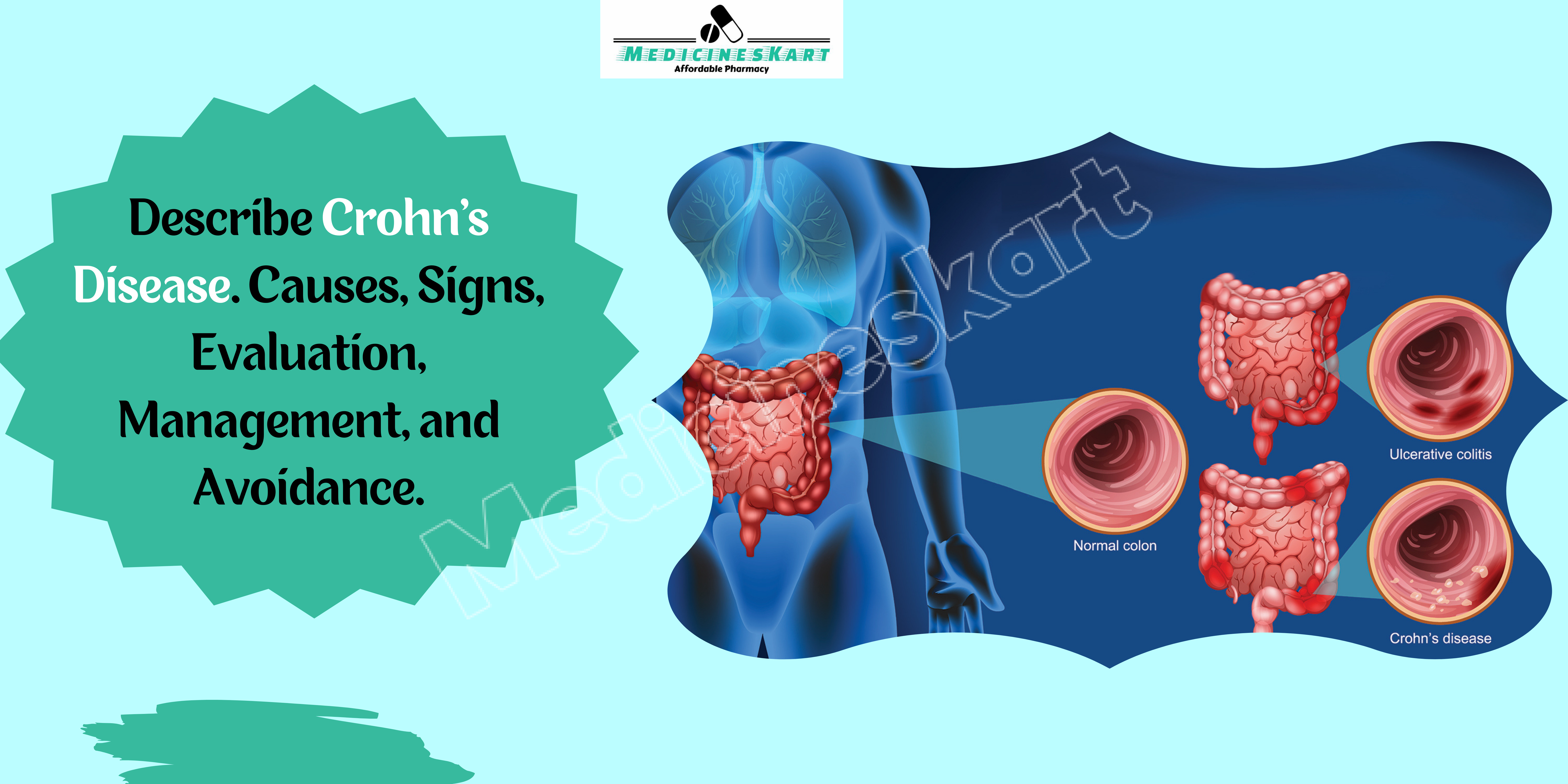 Describe Crohn's disease. Causes, Signs, Evaluation, Management, and Avoidance..png