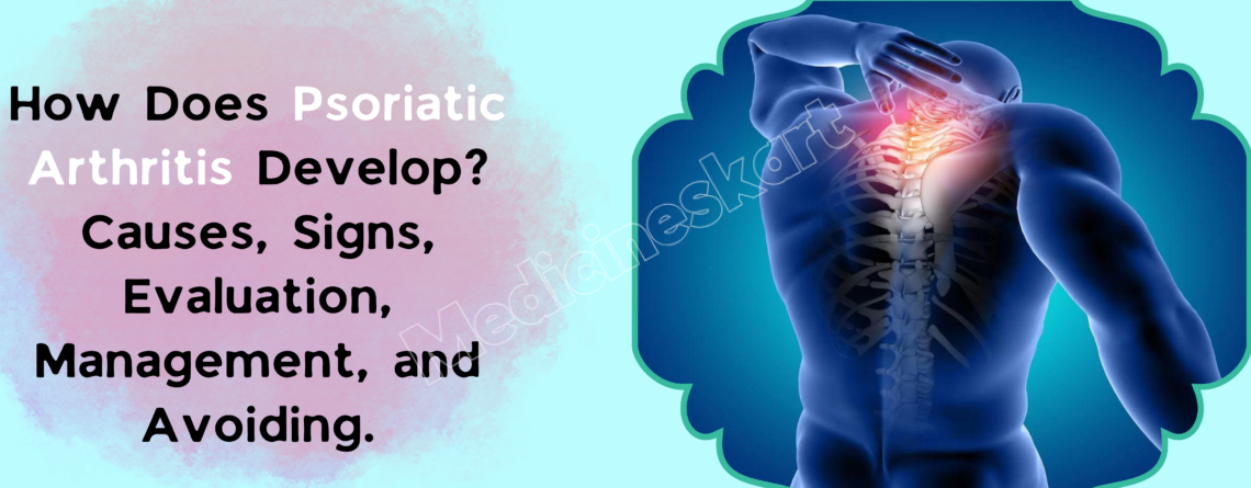 How Does Psoriatic Arthritis Develop Causes, Signs, Evaluation, Management, and Avoiding.