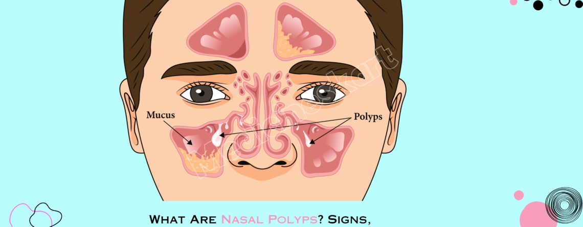 What Are Nasal Polyps? Signs, Factors, Treatment, Management, and Prevention.