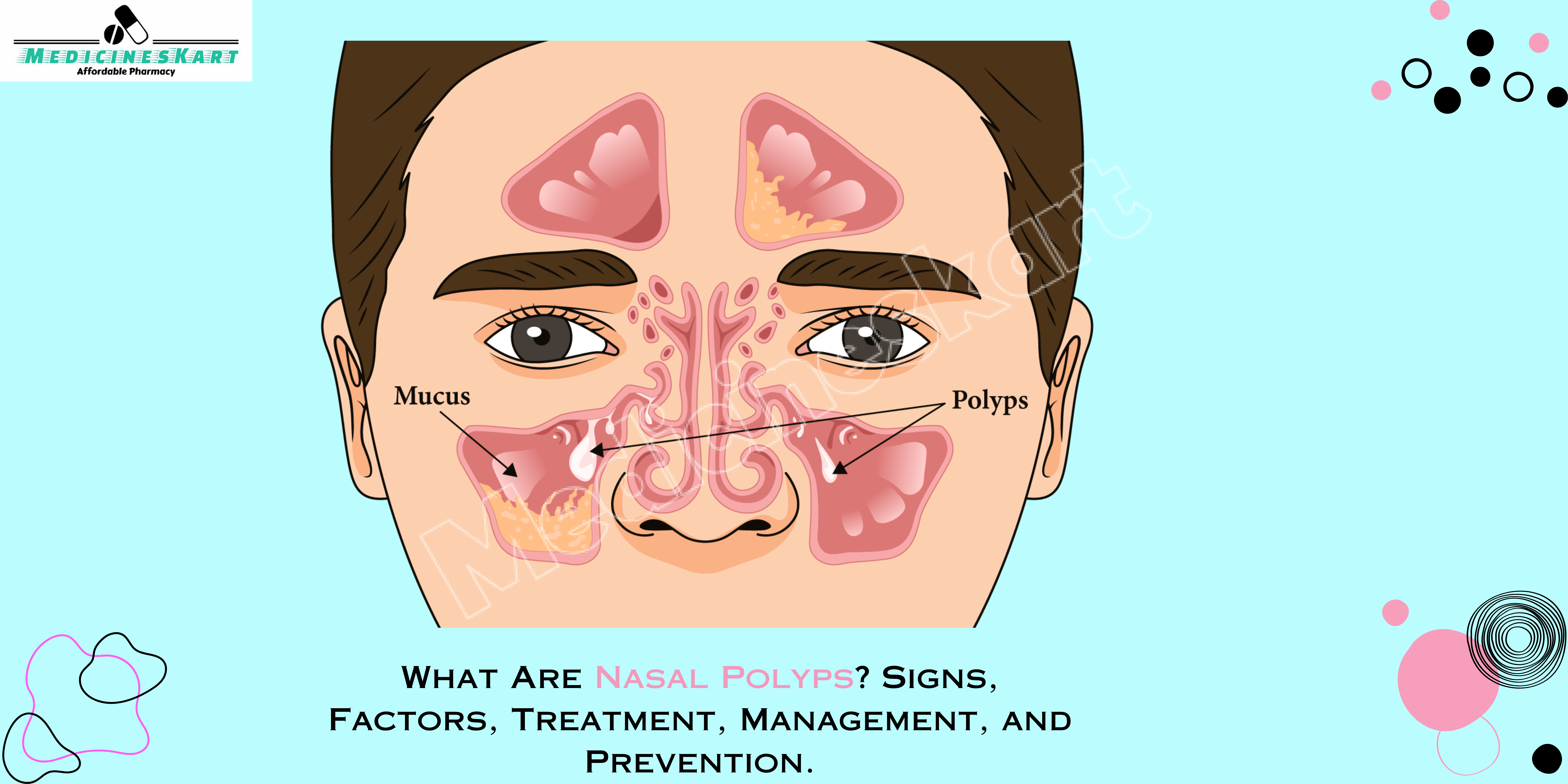 What Are Nasal Polyps? Signs, Factors, Treatment, Management, and Prevention.