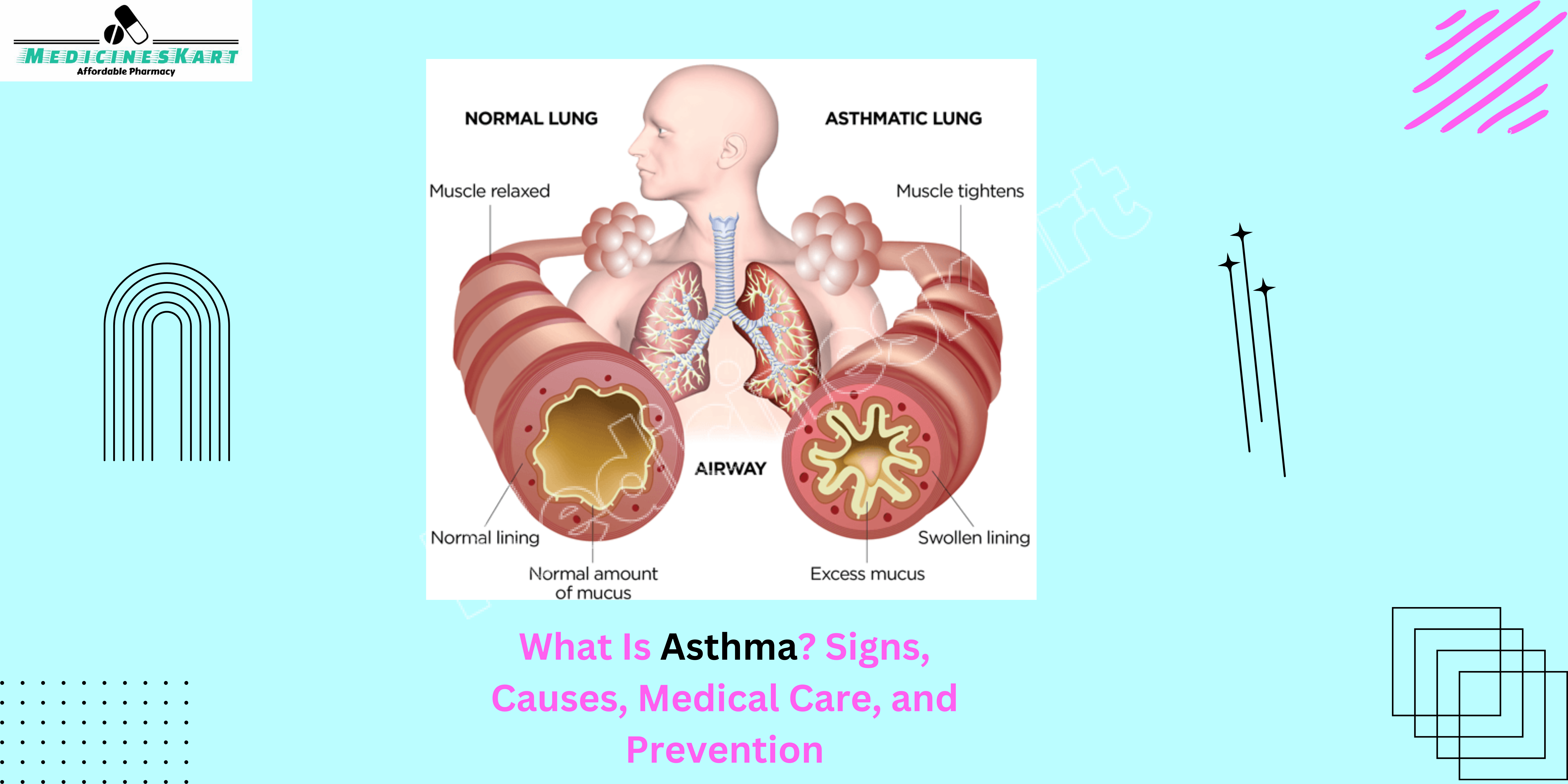 What Is Asthma? Signs, Causes, Medical Care, and Prevention.